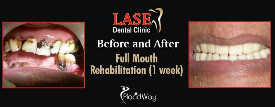 До и после имплантации зубов в Мумбаи, Индия Before and After Dental Implants in Mumbai, India